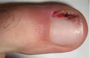Voorbeeld van een ingroeiende nagel